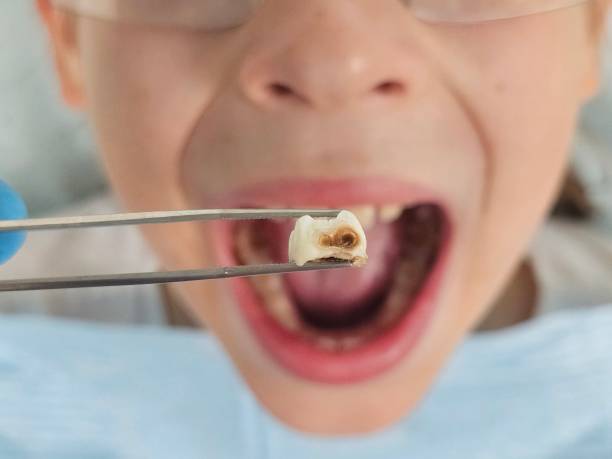 Best Emergency Treatment for Toothache in Powdersville, SC